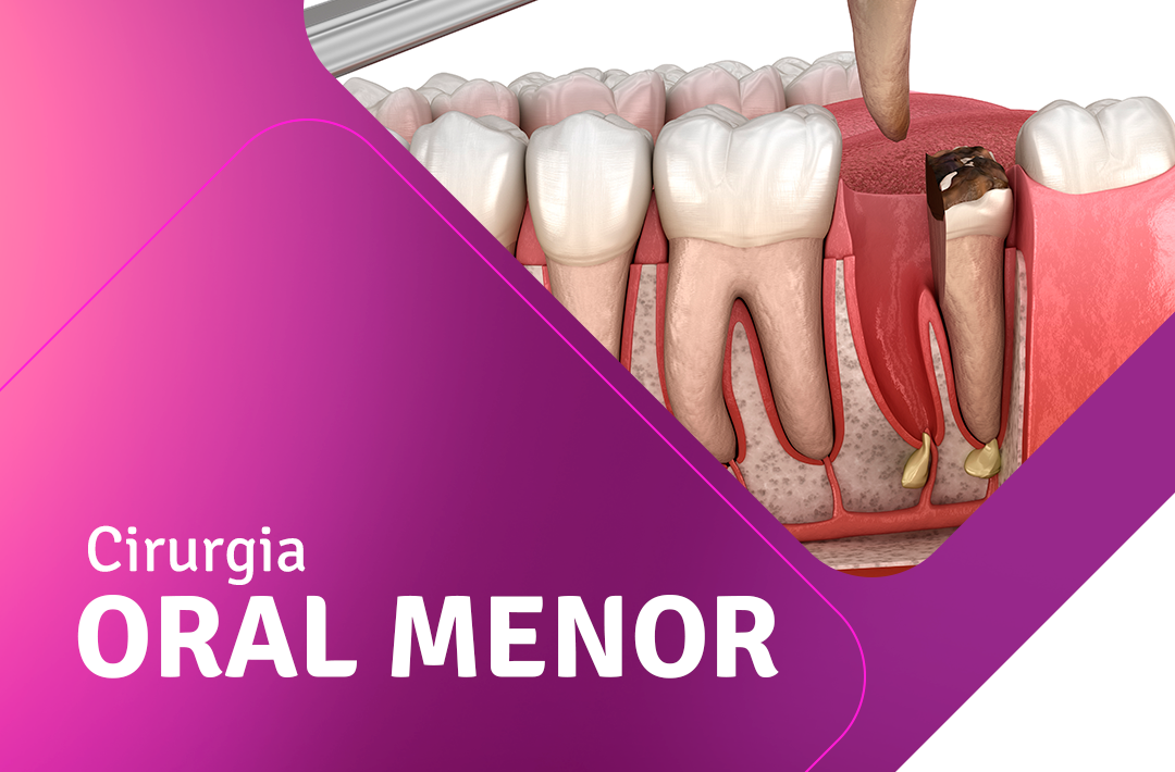 Ilustração de uma extração dental em um fundo roxo com os dizeres Cirurgia Oral Menor - Facop sorocaba