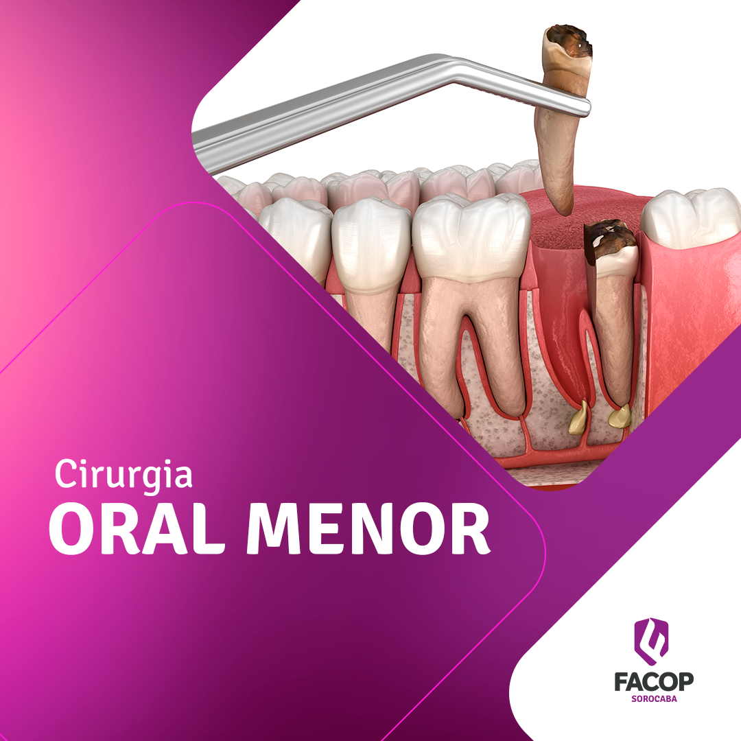 Ilustração de uma extração dental em um fundo roxo com os dizeres Cirurgia Oral Menor - Facop sorocaba