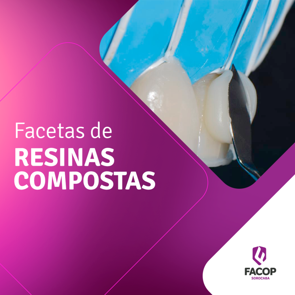 fotografia odontológica de uma arcada dentária real e sob um fundo roxo a mensagem Facetas de Resinas compostas Facop Sorocaba