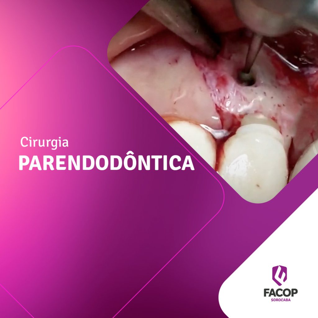 Fotomontagem na cor roxa com foto de uma cirurgia oral