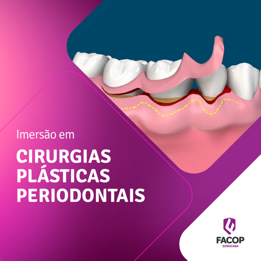 Cirurgia-Plastica-Perio